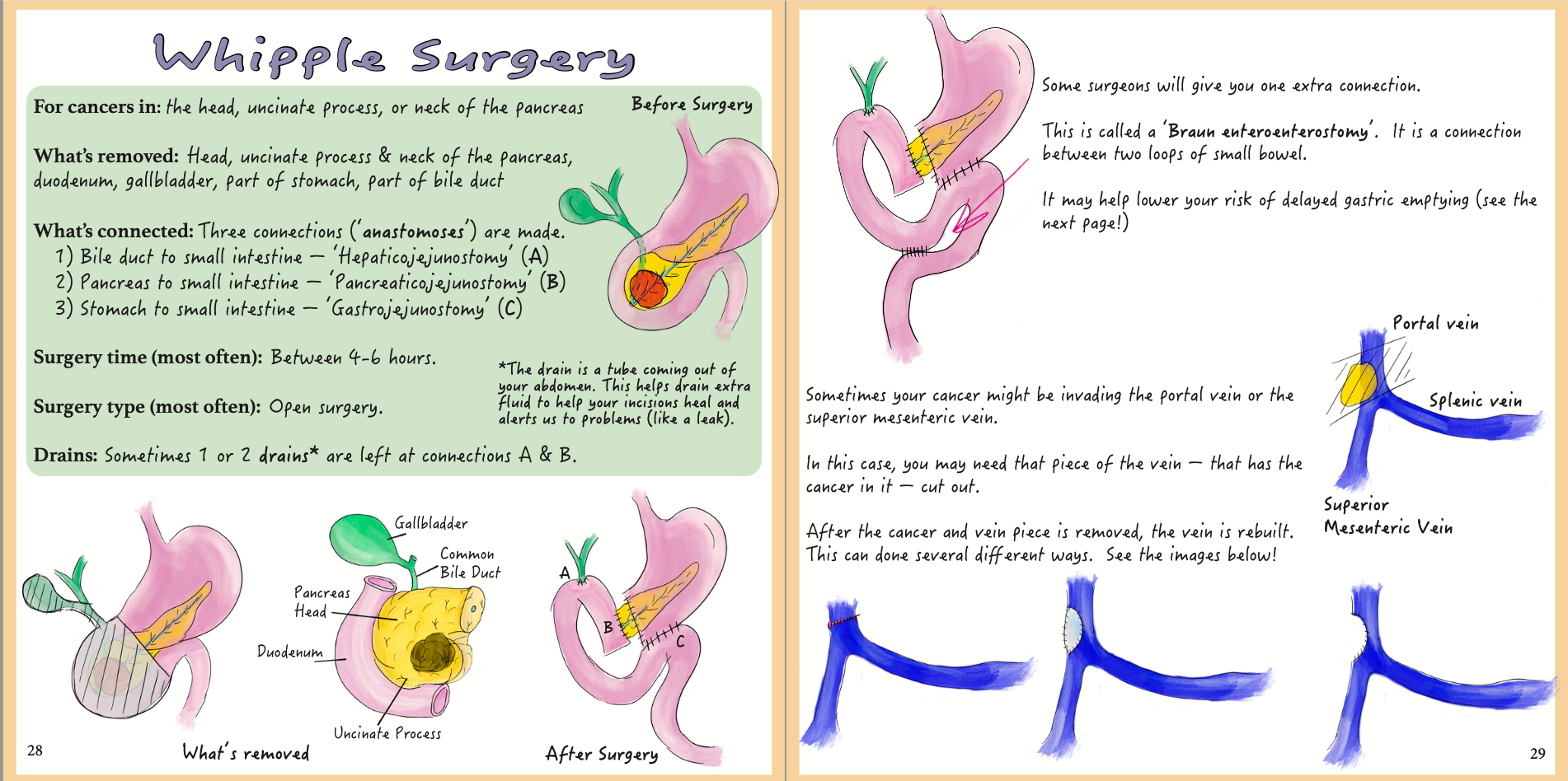 Pancreas Cancer: A patient-centered guide to diagnosis & treatment
